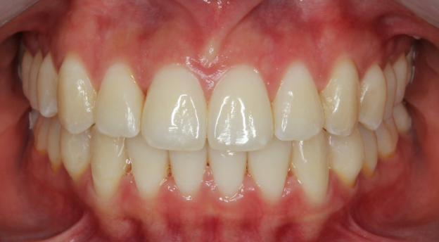 invisalign new york city
