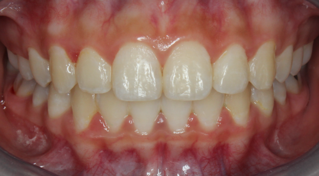 braces in new york