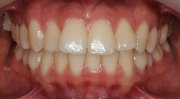 new york city invisalign