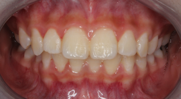 new york metal braces